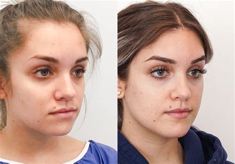 Brow Lift Before And After Gallery Dr Cory Torgerson