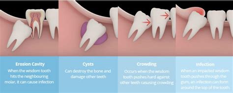 Wisdom Tooth Extractionremoval In Bangkok Thailand