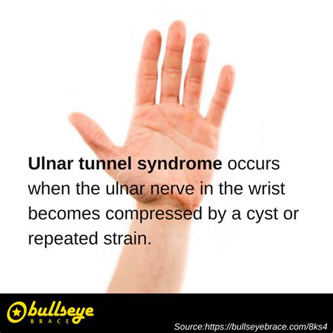 Pin On Ulnar Sided Wrist Pain And Tfcc Injuries