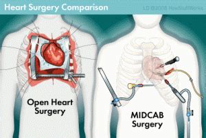 Open gallbladder surgery the general procedure is the same as for laparoscopic surgery, except that the surgeon reaches the gallbladder through a large, single incision in the abdominal wall. Is a Bypass Open Heart Surgery - Heart Surgery Information