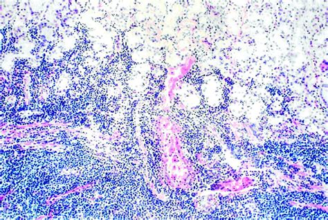 Non‐hodgkins Lymphoma Of Mucosa‐associated Lymphoid Tissue Cohen
