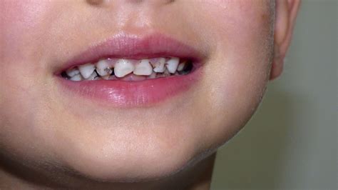 We did not find results for: Tooth decay in children | cavities are contagious too ...