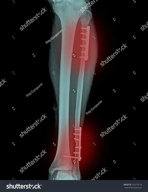 Film Xray Show Fracture Shaft Tibia Stock Photo Edit Now 222273118