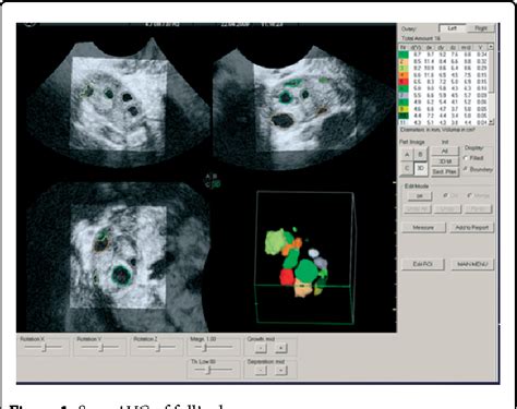 Figure 1 From The Role Of Three Dimensional Ultrasonography In Female