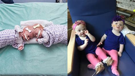 Formerly Conjoined Twins Doing Well Months After Successful Surgery At