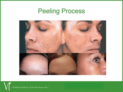 Chemical Peels Montclair Nj Melasma Treatment Sun Damaged Skin