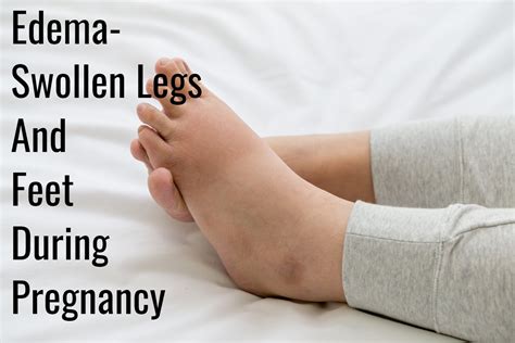 Edema Swollen Legs And Feet During Pregnancy Being The Parent