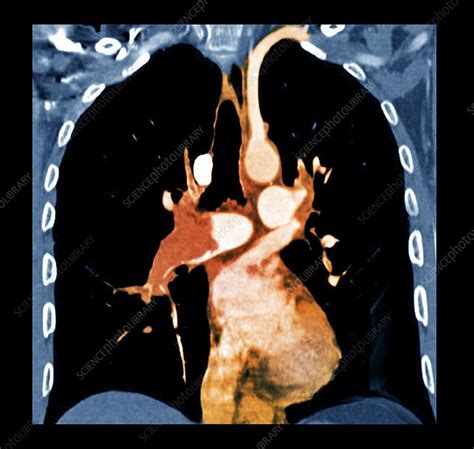 Pulmonary Embolism CT Scan Stock Image C Science Photo Library