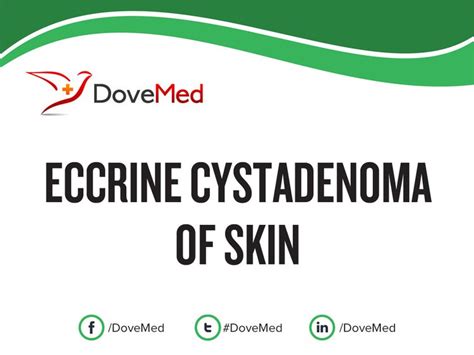 Eccrine Cystadenoma Of Skin