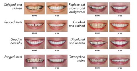 Tooth Shape Chart