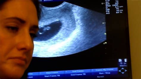 Ultrasound Miscarriage 4 Youtube