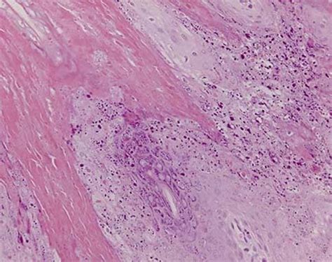 Compact Hyperkeratosis With Parakeratosis Acanthosis And Prominent