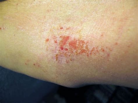 What Common Skin Rashes In Kids Look Like