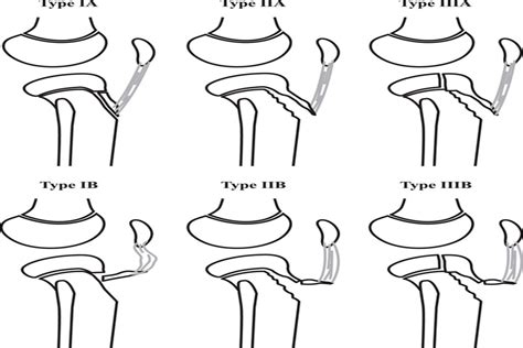 Tibial Tubercle Fractures Complications Classification An