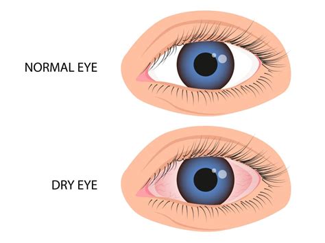 What Is Dry Eye Syndrome Causes Symptoms And More