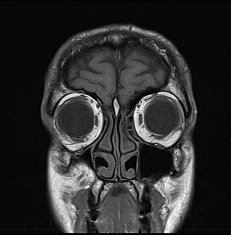 Mri Brain Scan Diagnostic Imaging Melbourne Radiology