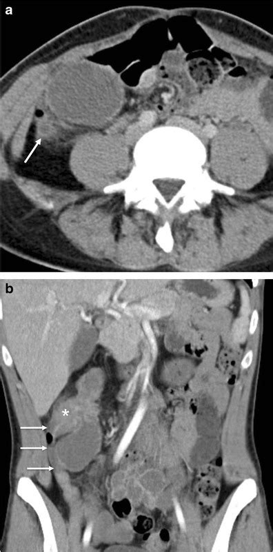 Acute Appendicitis Axial A And Coronal B Contrast Enhanced Ct Scan