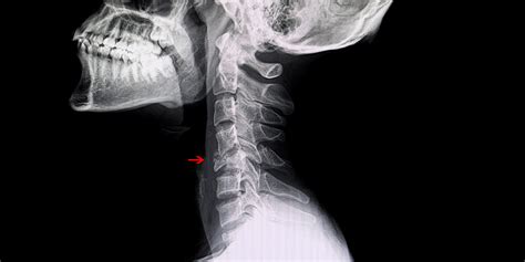 Lumbar Compression Fracture X Ray