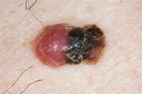 Malignant Melanoma On The Arm Stock Image C0033033 Science Photo