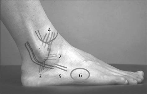 Es sind das ligamentum fibulotalare anterius (fta), das ligamentum fibulotalare posterius (ftp) und das ligamentum fibulocalcaneare (fca). Abb. 2 8 Fibulare Kette 13, 14. 1 Außenknöchel, 2 Lig ...