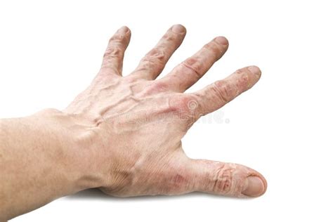 Psoriasis Skin Disease Stock Photo Image Of Fingers 109206618