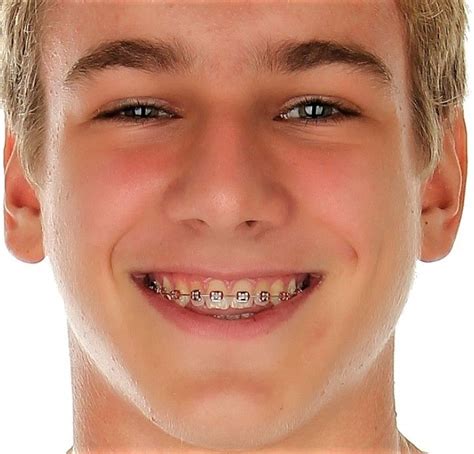 Pin By John Beeson On Guys In Braces Perfect Teeth Teeth Braces Braces