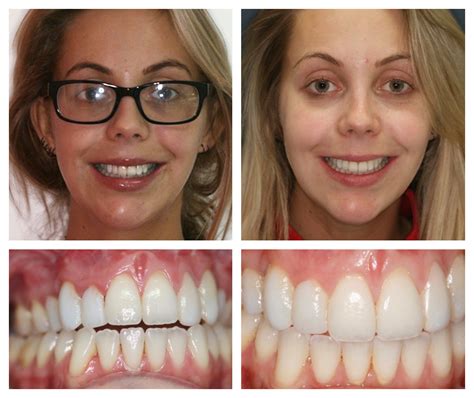 Invisalign Teeth Straightening Prestwich Whitefield Oakley Dental