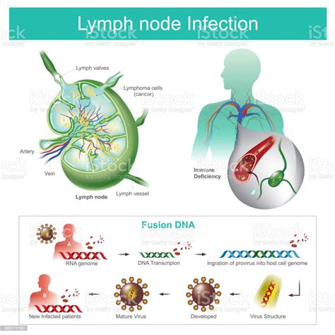 The Lymph Nodes Are Infected Failure Of The Immune System The Body More
