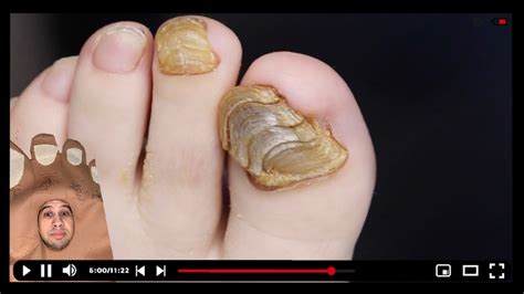 Crazy Toenail Shell Super Thick Nail Clipping Toebroclip Youtube