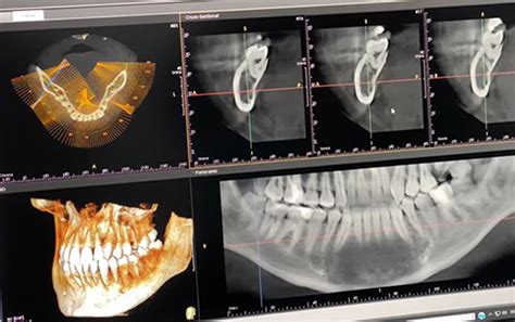 Caballo De Fuerza Gene Elegibilidad Radiografia Tac Dental Formar Melancolía Vatio