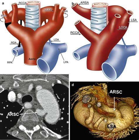 Right Aortic Arch With Aberrant Left Subclavian