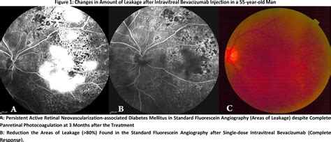 Figure 1 From Single Dose Intravitreal Bevacizumab After Complete