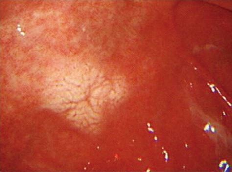Upper Gastrointestinal Endoscopic Findings Of Case 2 Endoscopic Image