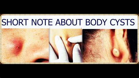 All You Need To Know About Cysts That Occur In Your Body Youtube