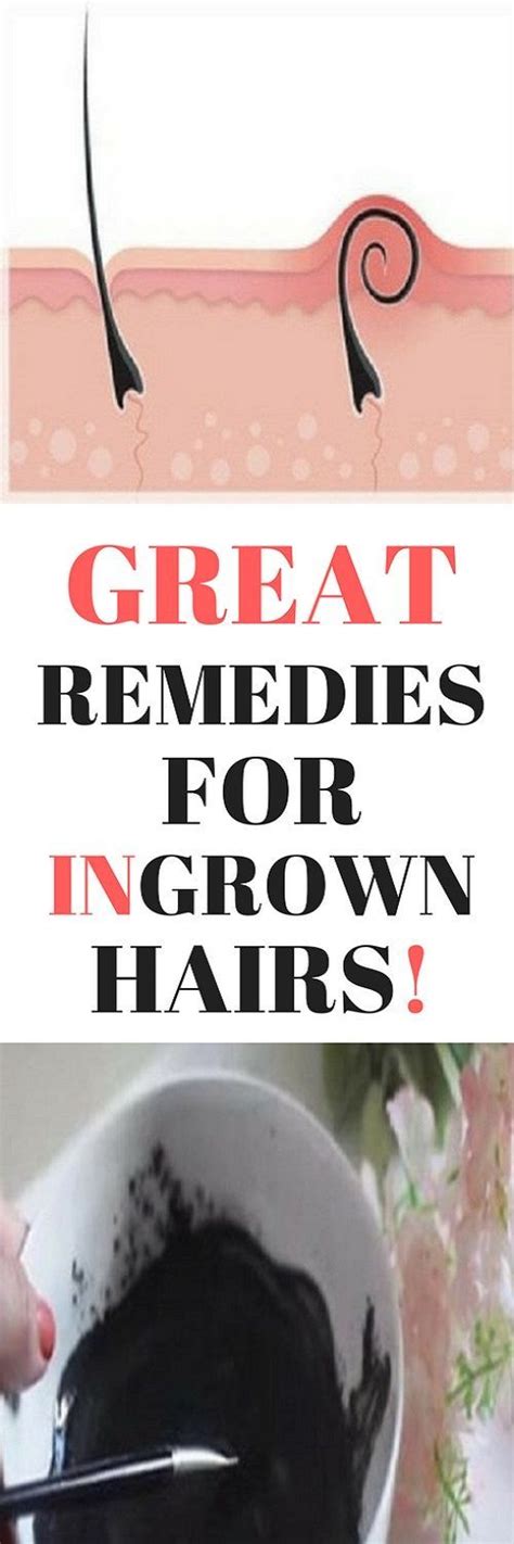 Great Remedies For Ingrown Hairs Ingrown Hair Remedies Ingrown Hair