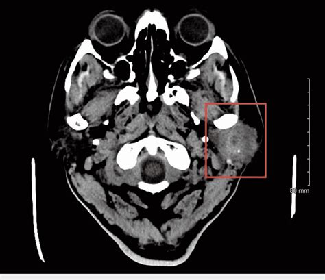 Ct Soft Tissue Neck With Contrast Showing Salivary Gland Tumor Centered