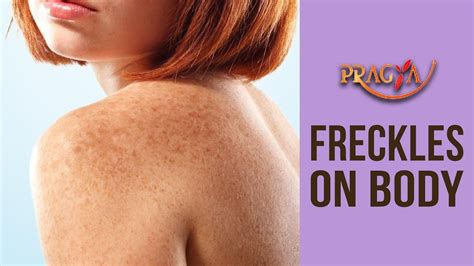 Freckles On Body Dr Dm Mahajan Dermatologist Youtube