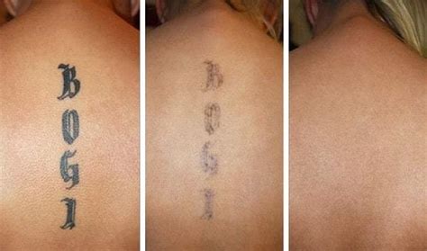 Уход после удаления татуажа лазером этапы заживления и уход за кожей