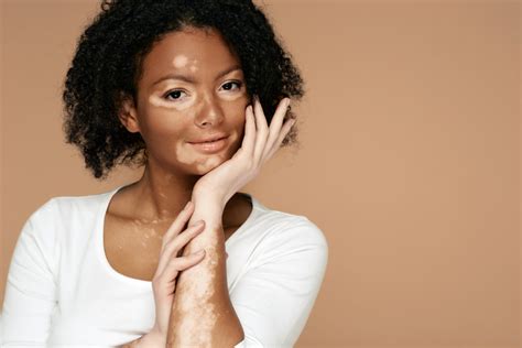 Vitiligo Symptoms Causes And Treatments Parade