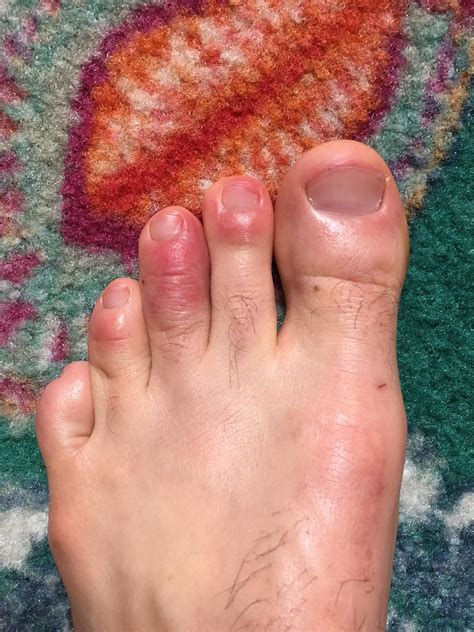 This rash appears suddenly and, over the. Can somebody help me identify this rash on my toes? : medical