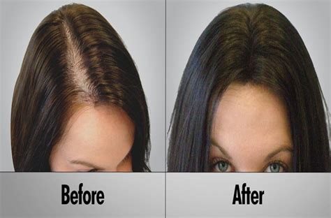 best hair loss treatment for female hair fashion online