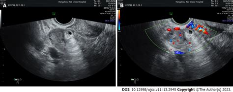 Comparison Of The Application Value Of Transvaginal Ultrasound And