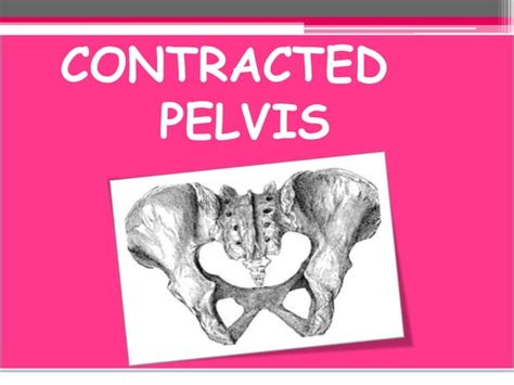 Cpd And Contracted Pelvis Ppt