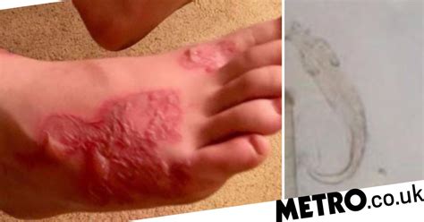 Boys Feet Infected With Worms After Friends Buried Him On Beach For