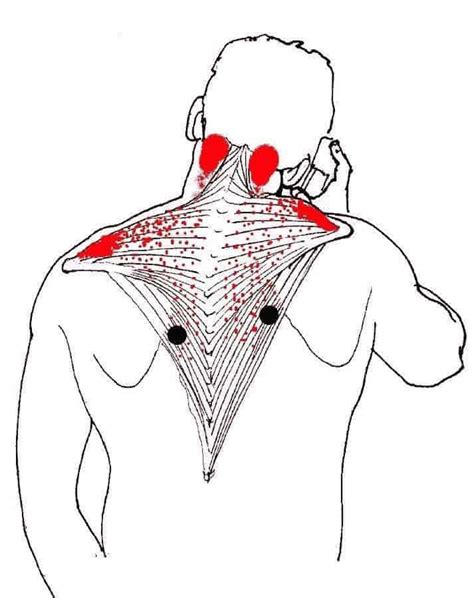Trigger Points What Are They And How Can Massage Help