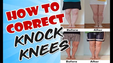 How To Correct Knock Knees Best Result For How To Correct Knock Knees