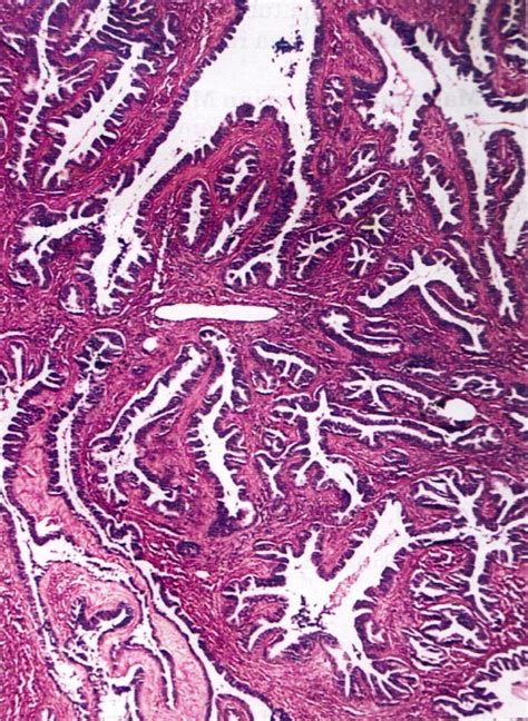 Pathology Outlines Serous Adenofibroma And Papilloma