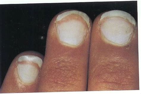 Nephrol renal dis, 2017 doi: Nailed It! - Nail Abnormalities and CKD - Tulane ...
