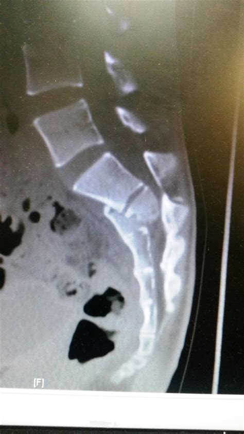 Sacral Fracture Orthobullets Query