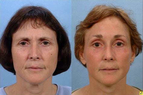 Face Lift Johns Hopkins Facial Cosmetic Surgery